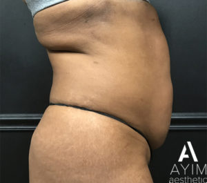 Liposuction: Before & After Photos