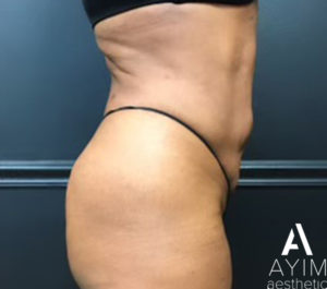 Liposuction: Before & After Photos