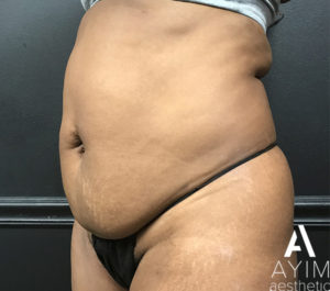 Liposuction: Before & After Photos