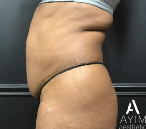 Liposuction: Before & After Photos