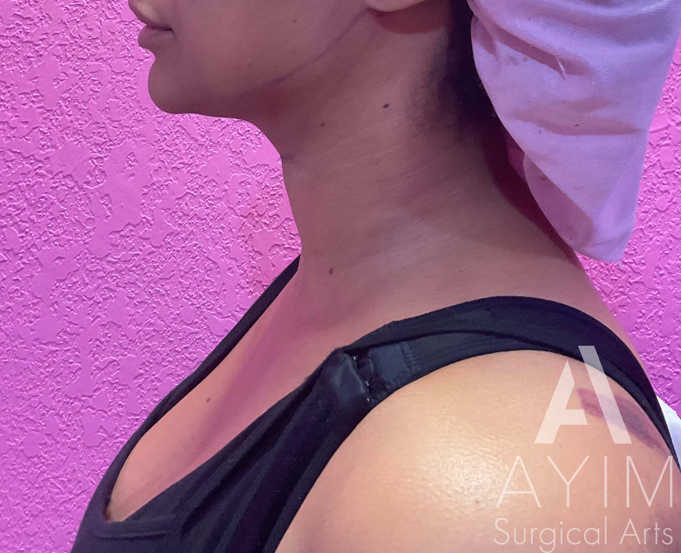 Liposuction of Chin and Neck Before and After Results