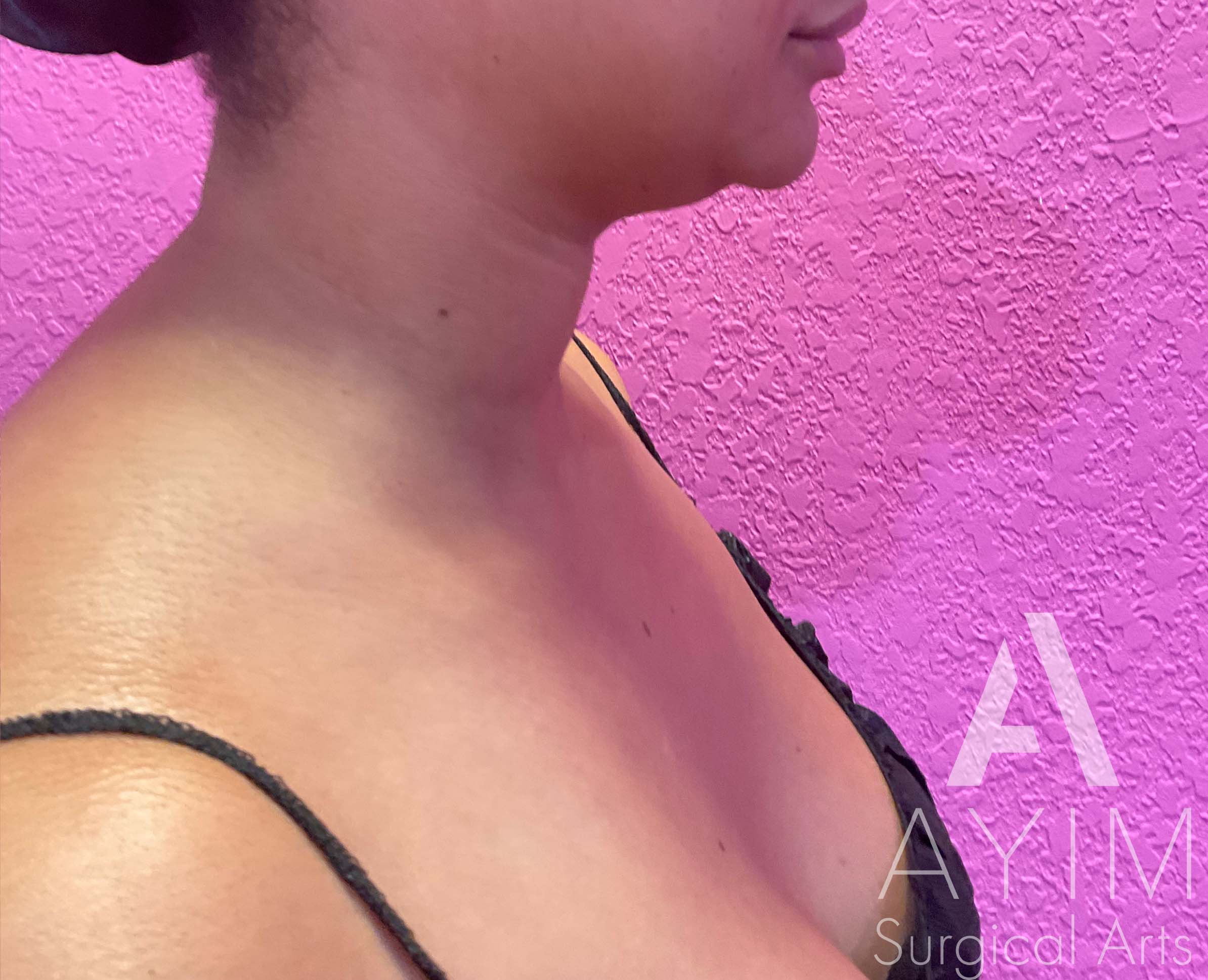 Liposuction of Chin and Neck Before and After Results