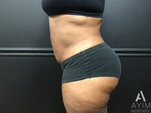 Bodytite: Before & After Photos Case 1399 After Photo Bodytite: Before & After Photos