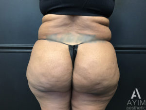 Bodytite: Before & After Photos Case 1399 Before Photo Bodytite: Before & After Photos