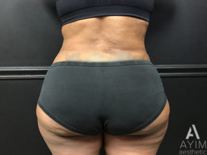 Bodytite: Before & After Photos