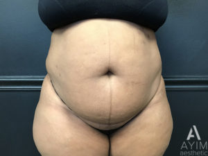 Bodytite: Before & After Photos Case 1399 Before Photo Bodytite: Before & After Photos