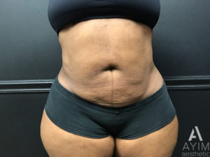 Bodytite: Before & After Photos Case 1399 After Photo Bodytite: Before & After Photos