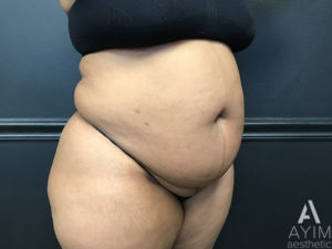 Bodytite: Before & After Photos Case 1399 Before Photo Bodytite: Before & After Photos