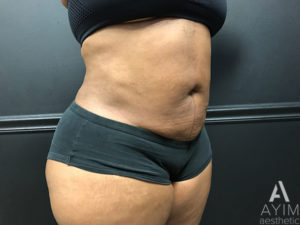 Bodytite: Before & After Photos Case 1399 After Photo Bodytite: Before & After Photos