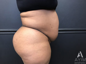 Bodytite: Before & After Photos Case 1399 Before Photo Bodytite: Before & After Photos