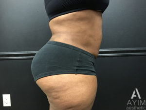 Bodytite: Before & After Photos Case 1399 After Photo Bodytite: Before & After Photos