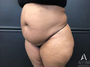Bodytite: Before & After Photos Case 1399 Before Photo Bodytite: Before & After Photos