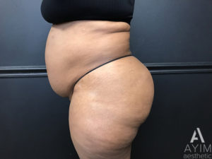 Bodytite: Before & After Photos Case 1399 Before Photo Bodytite: Before & After Photos