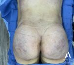 Liposuction: Before & After Photos