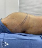 Liposuction: Before & After Photos