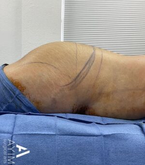 Liposuction: Before & After Photos