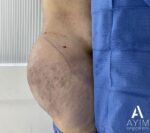 Liposuction: Before & After Photos