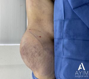 Liposuction: Before & After Photos