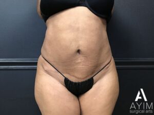 Bodytite: Before & After Photos