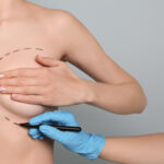 Combining a Breast Lift with Augmentation: Pros and Cons
