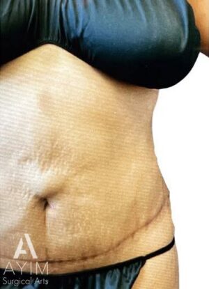 Abdominoplasty: Before & After Photos