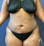 Abdominoplasty: Before & After Photos