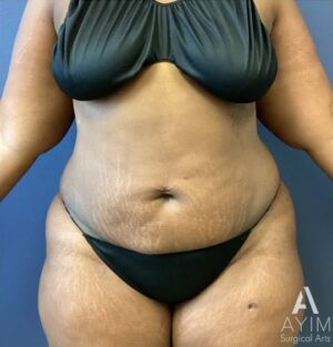 Abdominoplasty: Before & After Photos