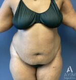 Abdominoplasty: Before & After Photos