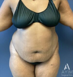 Abdominoplasty: Before & After Photos