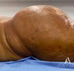 Brazilian Butt Lift: Before & After Photos
