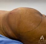 Brazilian Butt Lift: Before & After Photos
