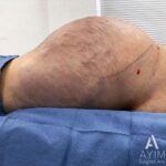 Brazilian Butt Lift: Before & After Photos