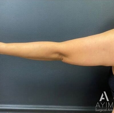 Bodytite: Before & After Photos