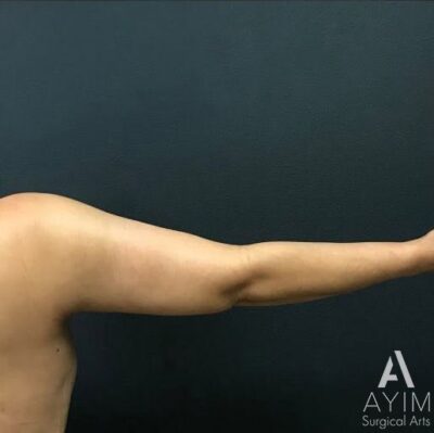 Bodytite: Before & After Photos