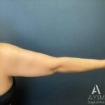 Bodytite: Before & After Photos