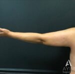 Bodytite: Before & After Photos