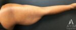 Bodytite: Before & After Photos