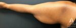 Bodytite: Before & After Photos