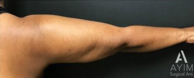 Bodytite: Before & After Photos