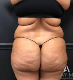 Bodytite: Before & After Photos