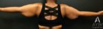 Bodytite: Before & After Photos
