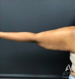 Bodytite: Before & After Photos