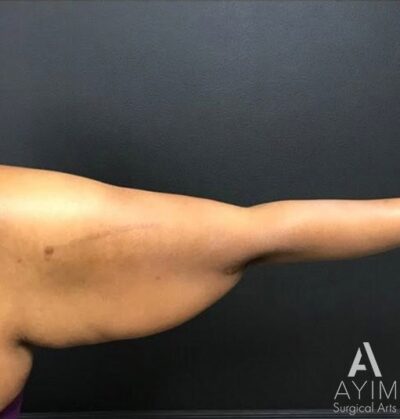 Bodytite: Before & After Photos