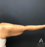 Bodytite: Before & After Photos