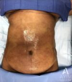Bodytite: Before & After Photos