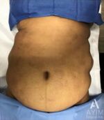 Bodytite: Before & After Photos