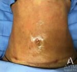 Bodytite: Before & After Photos