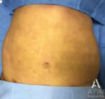 Bodytite: Before & After Photos