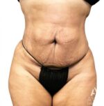 Bodytite: Before & After Photos