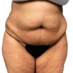 Bodytite: Before & After Photos